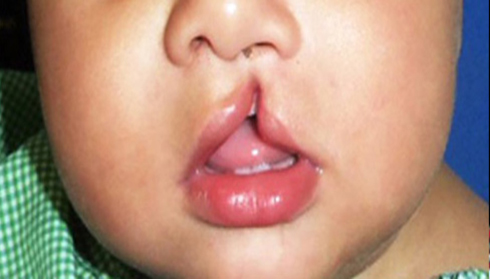  Расцеп на усните и непцето